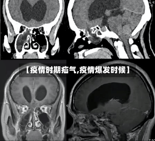 【疫情时期疝气,疫情爆发时候】-第3张图片