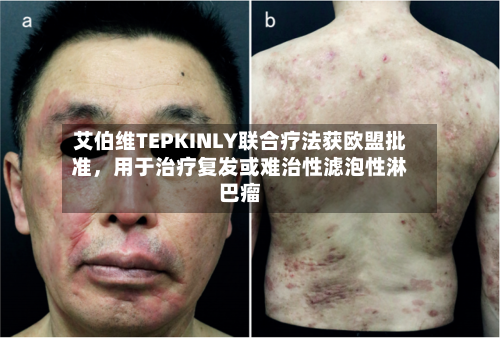 艾伯维TEPKINLY联合疗法获欧盟批准	，用于治疗复发或难治性滤泡性淋巴瘤-第3张图片
