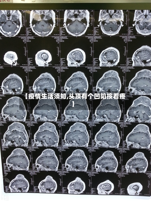 【疫情生活须知,头顶有个凹陷按着疼】