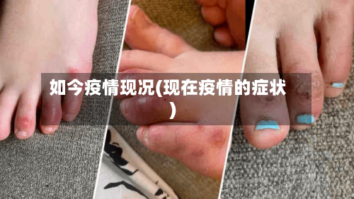 如今疫情现况(现在疫情的症状)-第2张图片