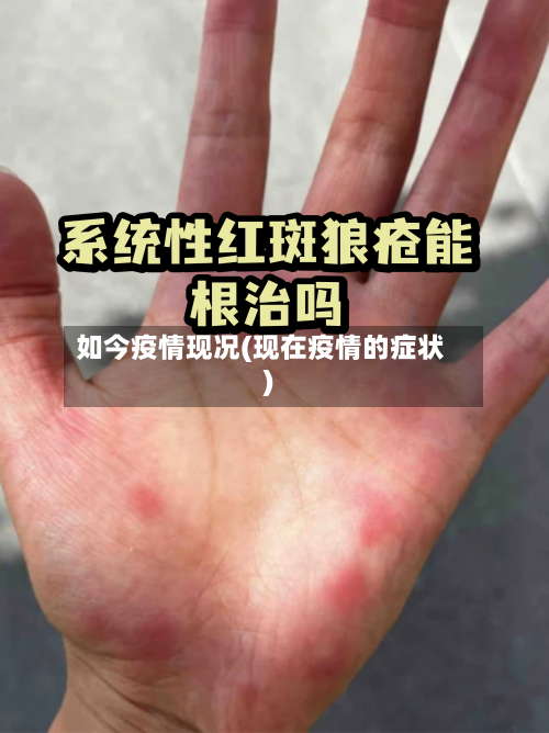 如今疫情现况(现在疫情的症状)-第3张图片